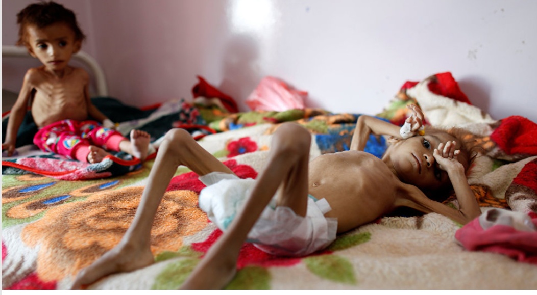 (بسبب العدوان والأوبئة): وفاة 100 ألف طفل يمني سنوياً